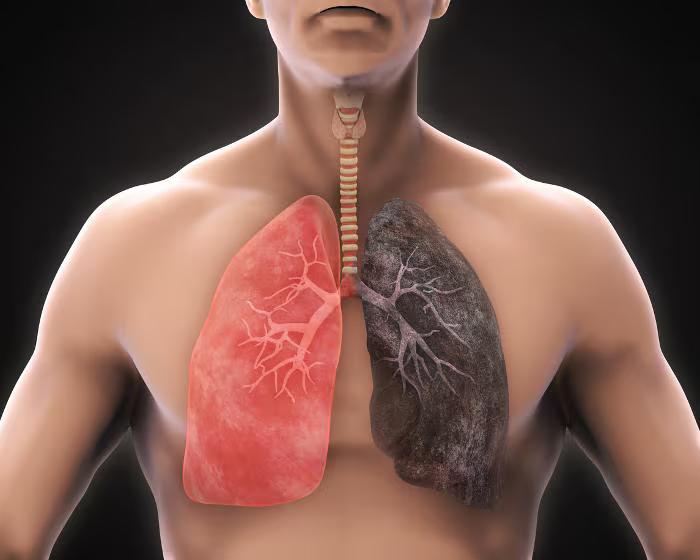 Immagine articolo Broncopneumopatia Cronica Ostruttiva (BPCO)