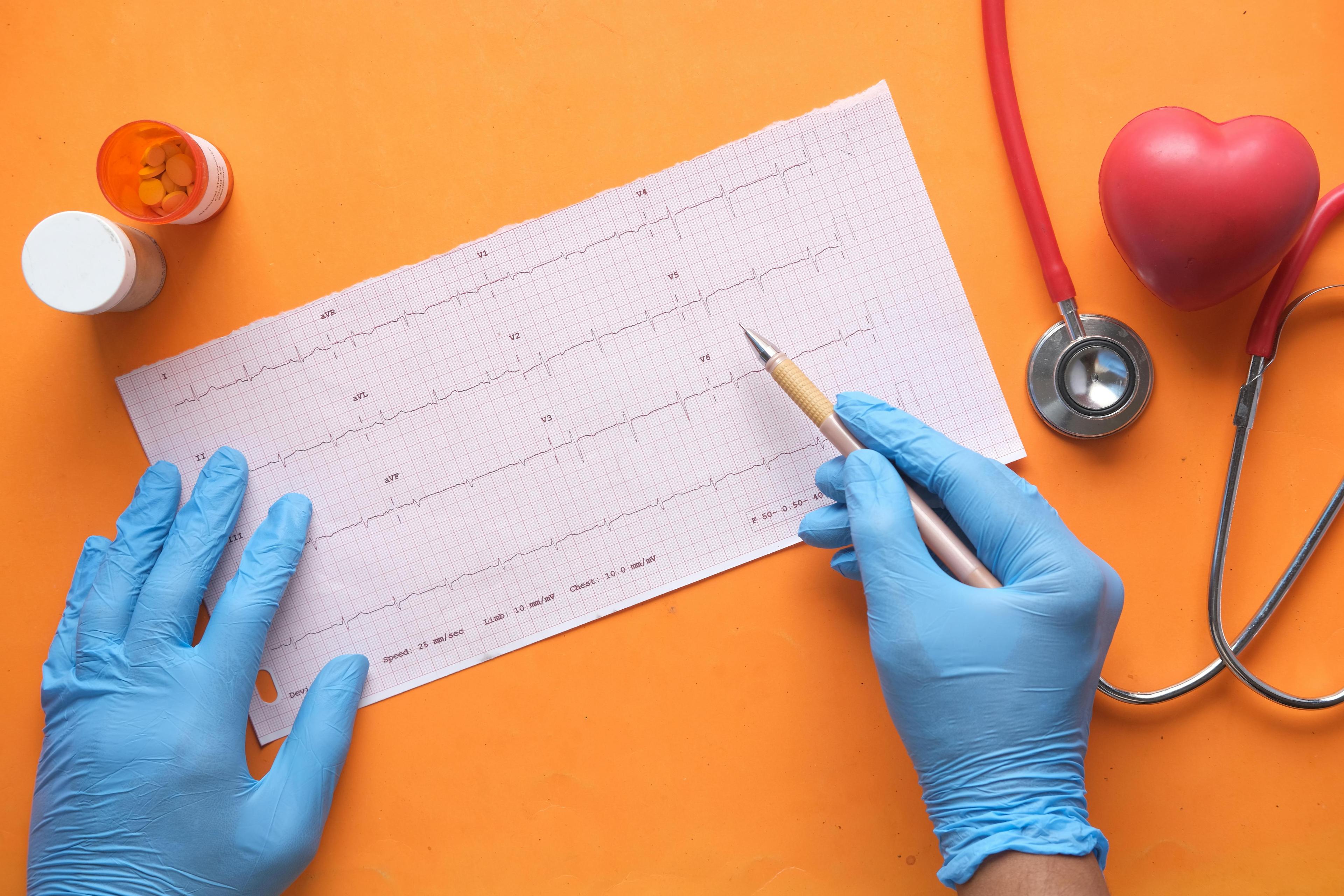 Immagine articolo Infarto del Miocardio