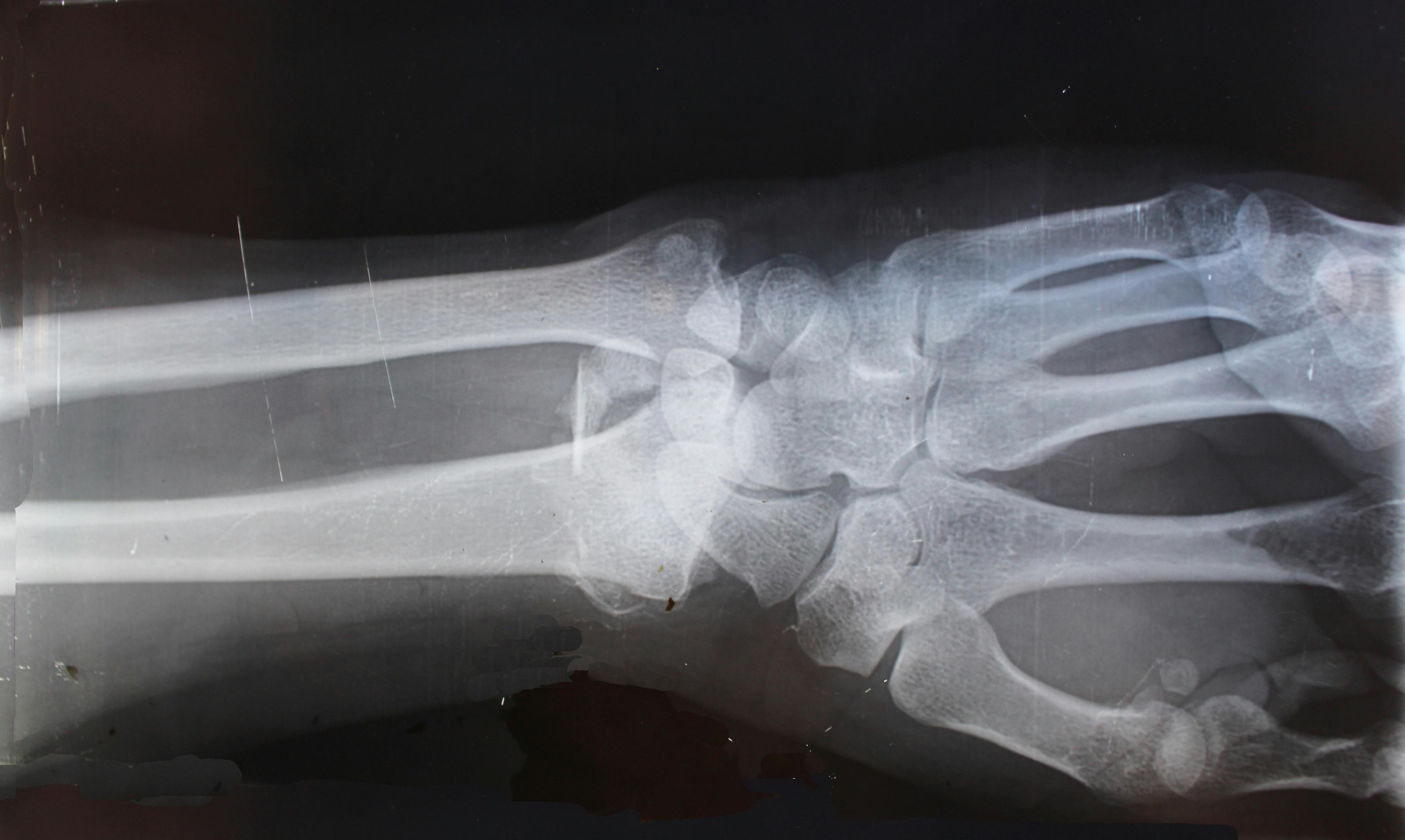 Immagine articolo Osteoporosi in Menopausa